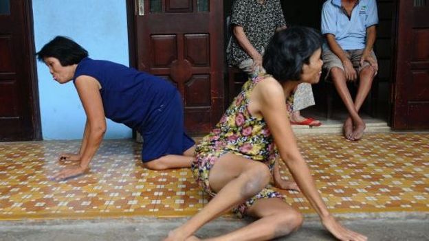 L'agent orange, rsponsable de handicaps